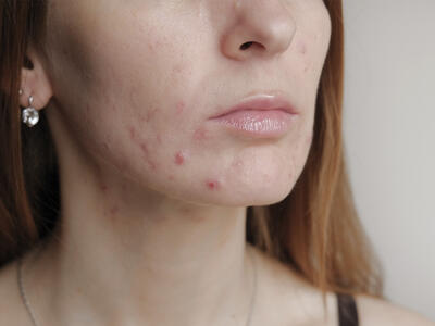 Allergisk reaktion overfor makeup